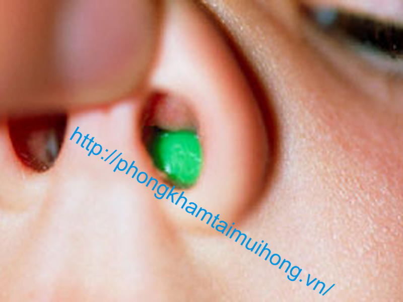Dị vật mũi