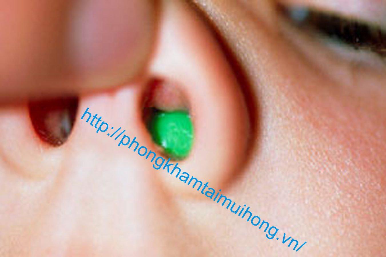 Dị vật mũi